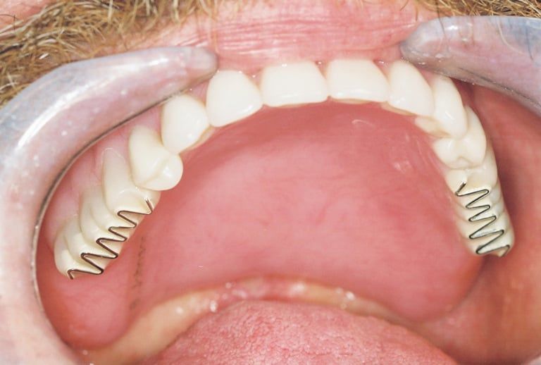 Cutter Bar Dentures